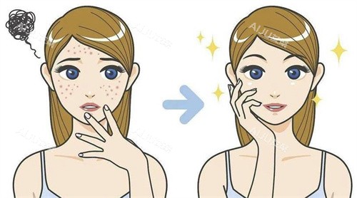 点阵激光去痘印卡通图