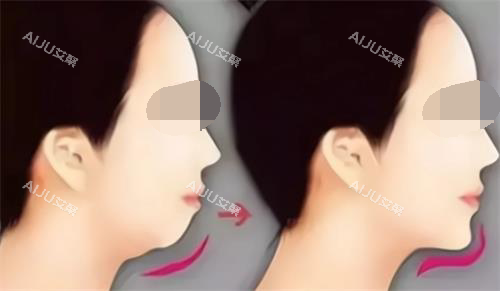 丰下巴后的成效