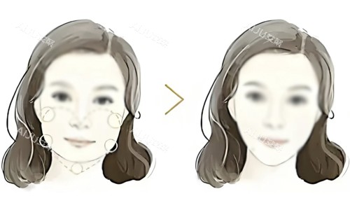 面部吸脂对比