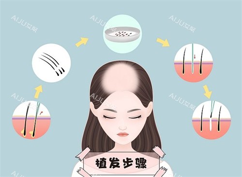 植发步骤流程图