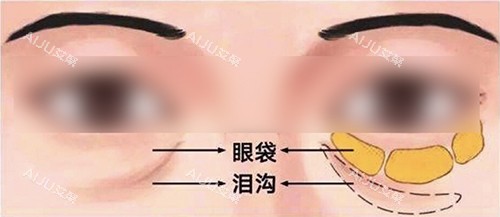 泪沟