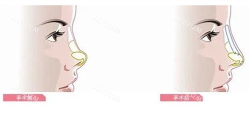 隆鼻手术前后对比