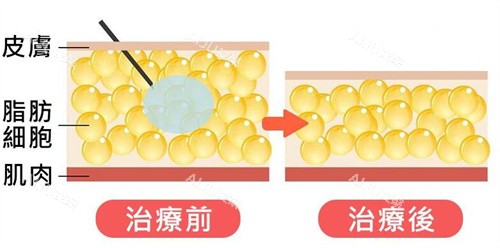粒子流轰脂机原理卡通图展示