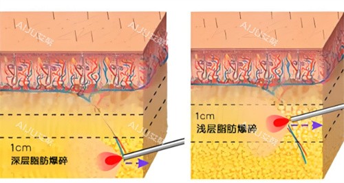 粒子流轰脂机作用皮肤层图