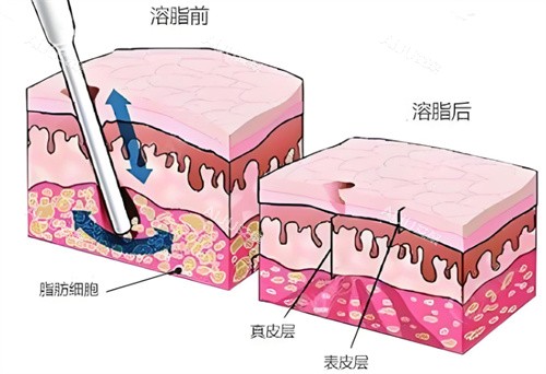粒子流轰脂机皮肤层