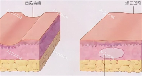 皮肤表面凹凸不平的动画展示