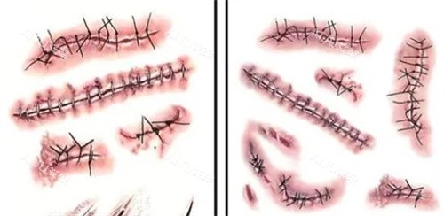 不同的手术疤痕 不同的手术疤痕