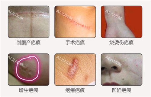 不同类型疤痕图片 不同类型疤痕图片
