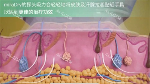 miraDry清新微波是什么