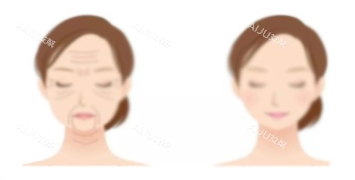 热玛吉提升前后对比 热玛吉提升前后对比