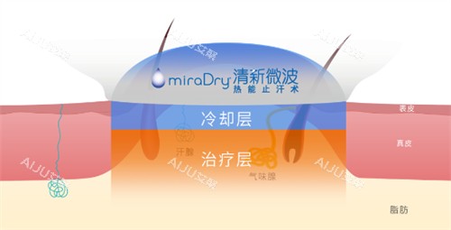 miraDry清新微波作用层次