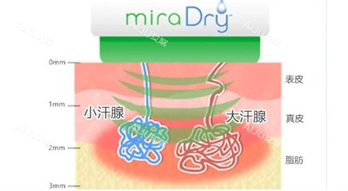 清新微波治疗原理