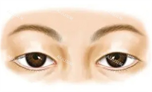 未做手术前的上眼睑下垂