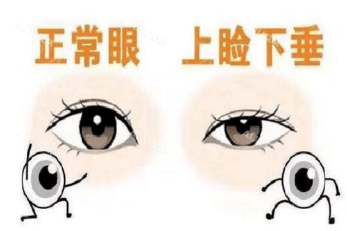 正常眼和眼睑下垂对比