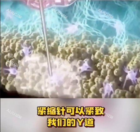 歌莉兰紧缩针注射怎么样
