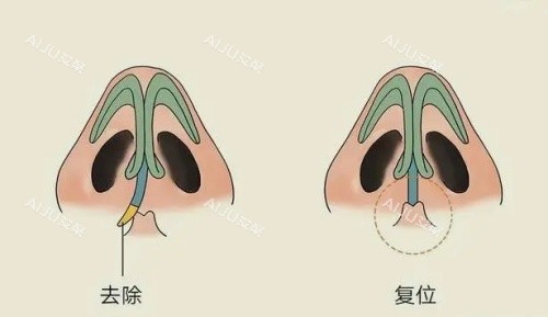 鼻子被打歪了矫正多少钱？1万-5万元不等！影响费用的3大关键因素需注意