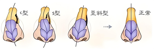 歪鼻矫正类型