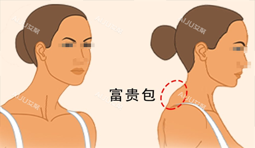 深圳曹孟君治疗富贵包咋样？曹孟君富贵包收费价目表、技术及口碑一览