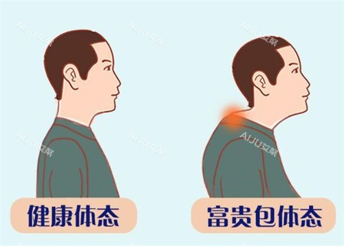 深圳曹孟君健康体态和富贵包体态的区别