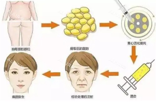 脂肪填充费用一般多少钱？2025年各部位价格表一查，面部填充4800起