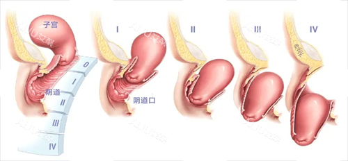 子宫脱垂程度对比图