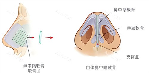 怀化宸美整形王先成隆鼻鼻中隔软骨鼻