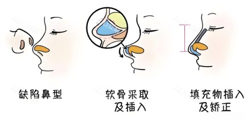 南开博莱美整形医院怎么样？刘旺做原生态眼综合/鼻综合/轮廓/内窥镜隆胸经验多评价高