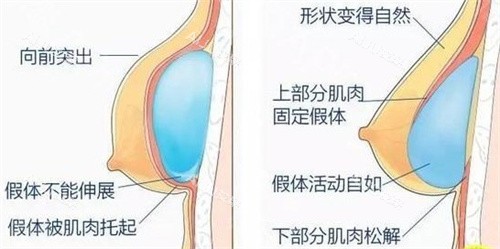 谢义德胸部整形