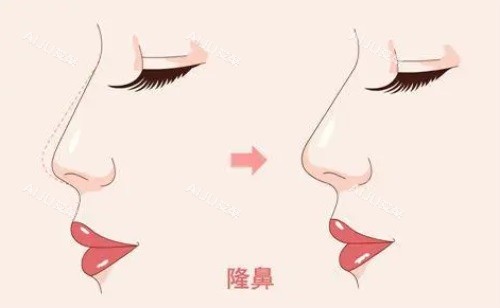牛永敢医生隆鼻对比图