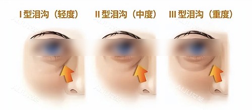 泪沟类型