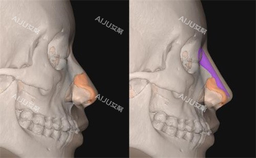 FITme3D鼻假体模拟隆鼻展示
