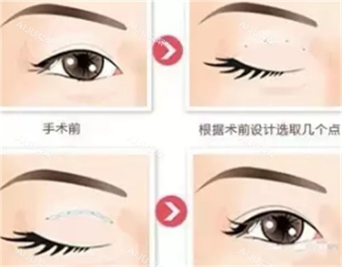 郑州孟宝玺医生贝塞尔双眼皮手术过程图解