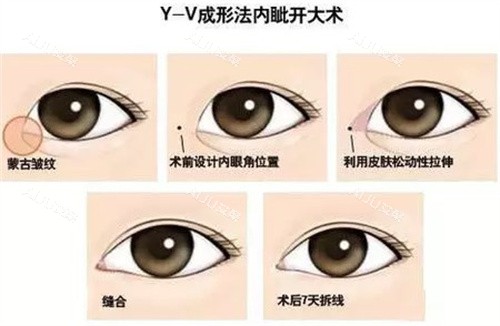广州孙沣开眼角Y-V成型法