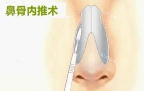 鼻骨内推示意图