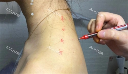 直角肩注射设计