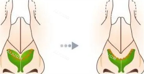 鼻翼软骨