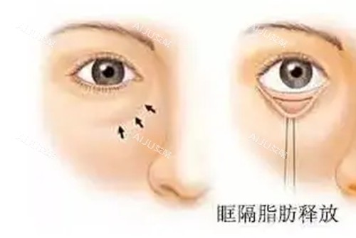 深圳曙光和健丽去眼袋哪个更好？曙光内切去眼袋3800元起，健丽小创口3400元起，快比技术差异！