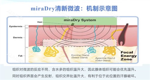 miraDry清新微波机制示意图