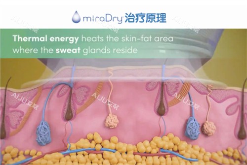 miraDry清新微波治疗原理