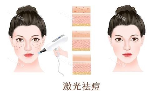 激光祛痘前后的对比
