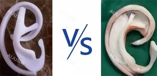 耳再造自体肋软骨和生物材料对比 耳再造自体肋软骨和生物材料对比