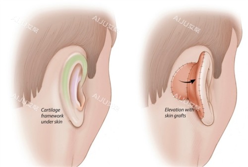 成都陈再洪畸形的耳朵 成都陈再洪畸形的耳朵