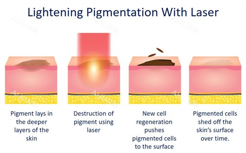 崔玮医生祛斑如何改善皮肤斑点