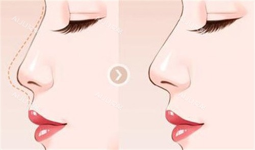 成都游晓波隆鼻手术对比图