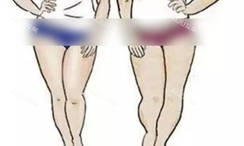 大腿吸脂手术术前肉肉图