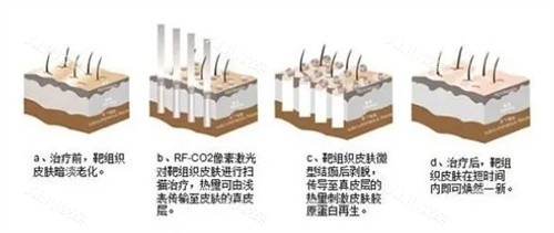 点阵激光治疗原理