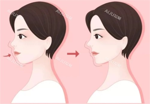 如何分辨自己是不是凸嘴
