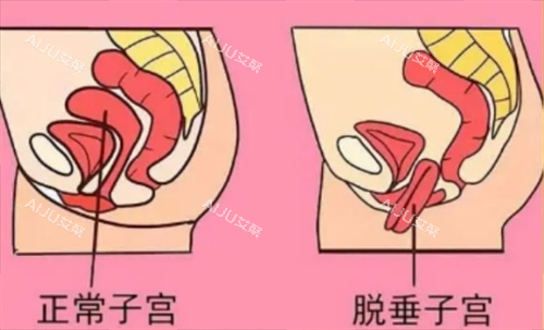 子宫脱垂对比展示