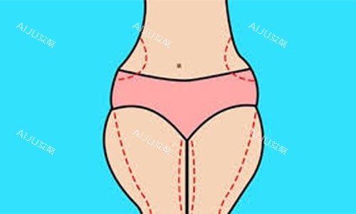 曾德浩大腿吸脂手术设计方案示意图