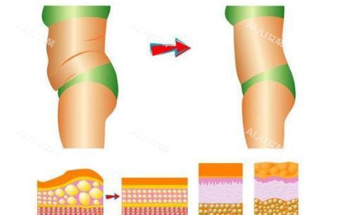 曾德浩腰腹吸脂对比图